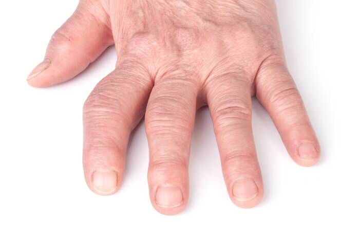 artrosi deformante sulle mani