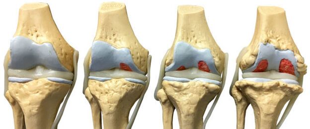 danno articolare nelle diverse fasi di sviluppo dell'artrosi della caviglia