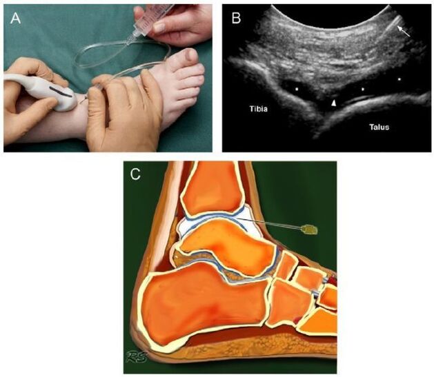 ecografia dell'articolazione della caviglia con artrosi