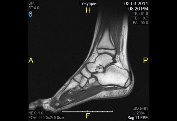 immagine della caviglia per l'artrosi