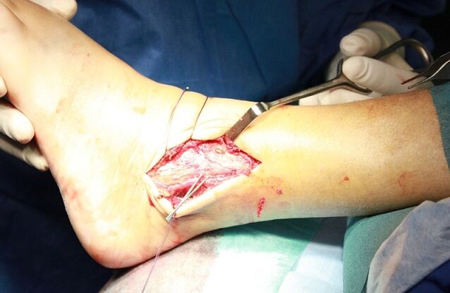 intervento chirurgico per artrosi della caviglia