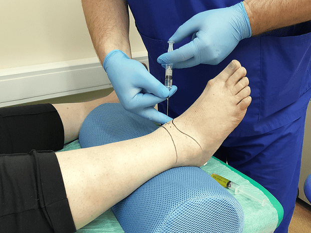 puntura per artrosi dell'articolazione della caviglia