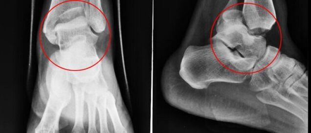 radiografia per artrosi della caviglia
