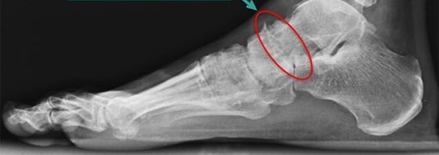 scintigrafia per artrosi della caviglia