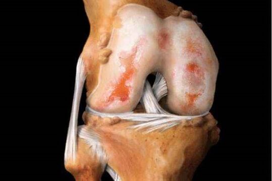 danno all'articolazione del ginocchio con artrosi