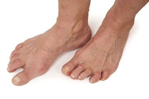 piedi affetti da artrosi