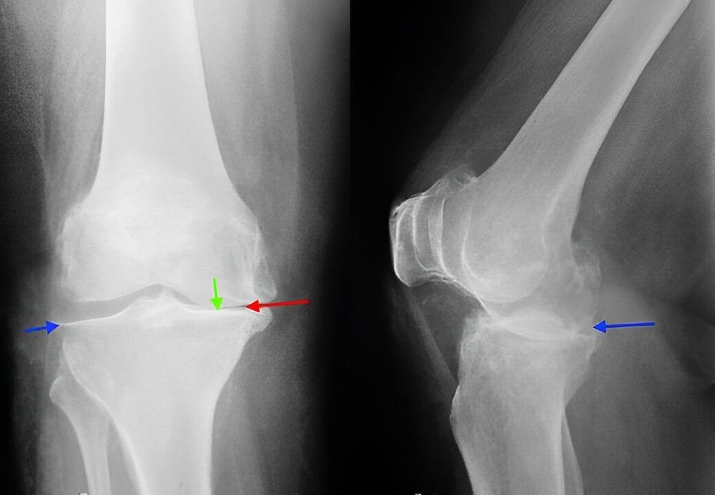 radiografia dell'artrosi dell'articolazione del ginocchio