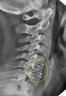 Restringimento dello spazio intervertebrale alla radiografia