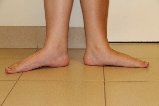 A volte la causa dell'artrosi del collo sono i piedi piatti