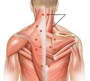 miosite come causa del mal di schiena