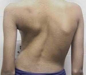 scoliosi come causa del mal di schiena