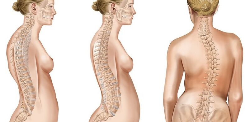 La scoliosi della colonna vertebrale toracica provoca dolore alle scapole