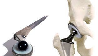 artroplastica dell'articolazione dell'anca per l'artrosi