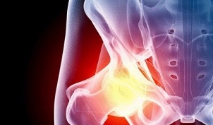 cause dello sviluppo dell'artrosi dell'anca