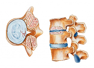 Osteocondrosi