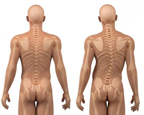 Scoliosi della colonna vertebrale