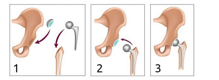 Artroplastica dell'anca