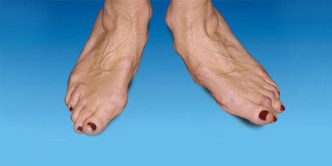deformità del piede con artrosi della caviglia