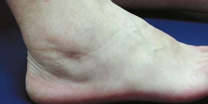 gonfiore della caviglia con artrosi