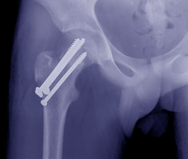 Radiografia dell'articolazione dell'anca, osteosintesi della frattura con dispositivi di fissazione interna