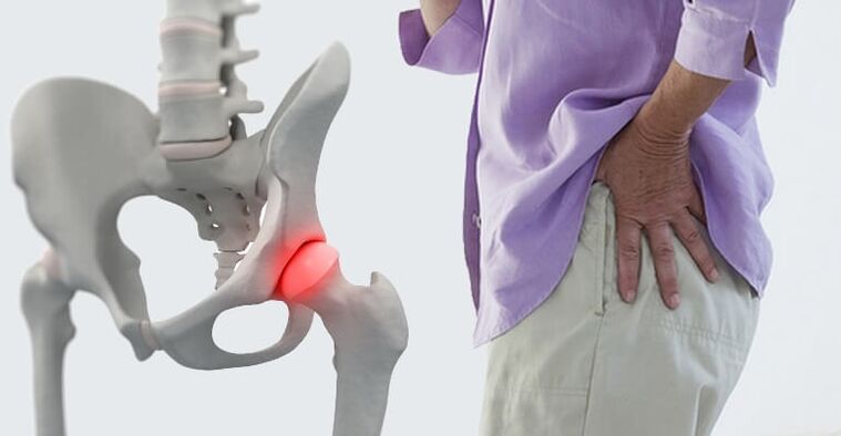 dolore nella zona dell'anca - un sintomo di artrosi dell'articolazione dell'anca