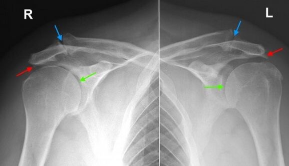 Radiografia delle articolazioni della spalla